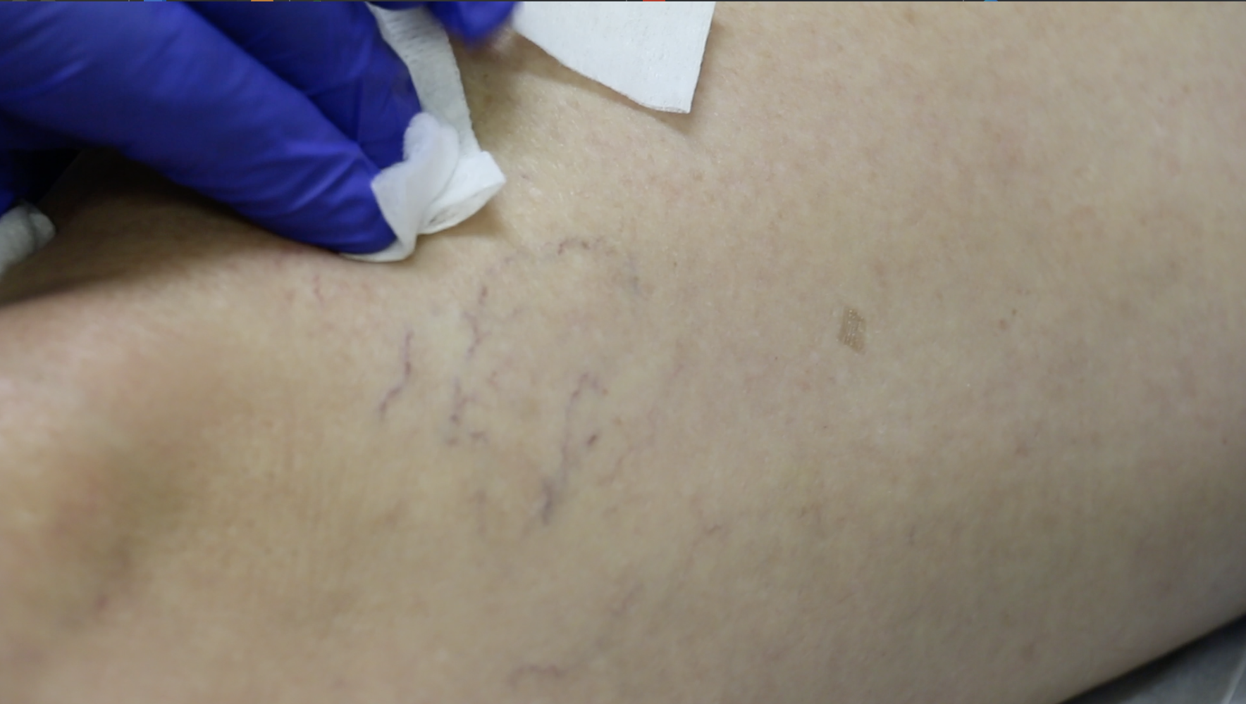 Side effects of sclerotherapy for varicose veins include bruising and sore spots