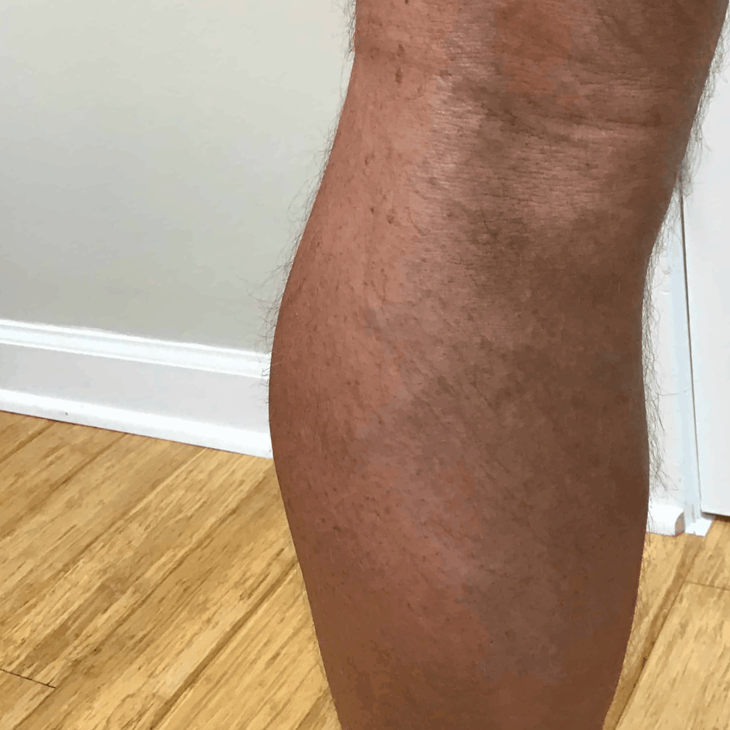 What is Venous Insufficiency? - Vein Care Center of Amelia Island