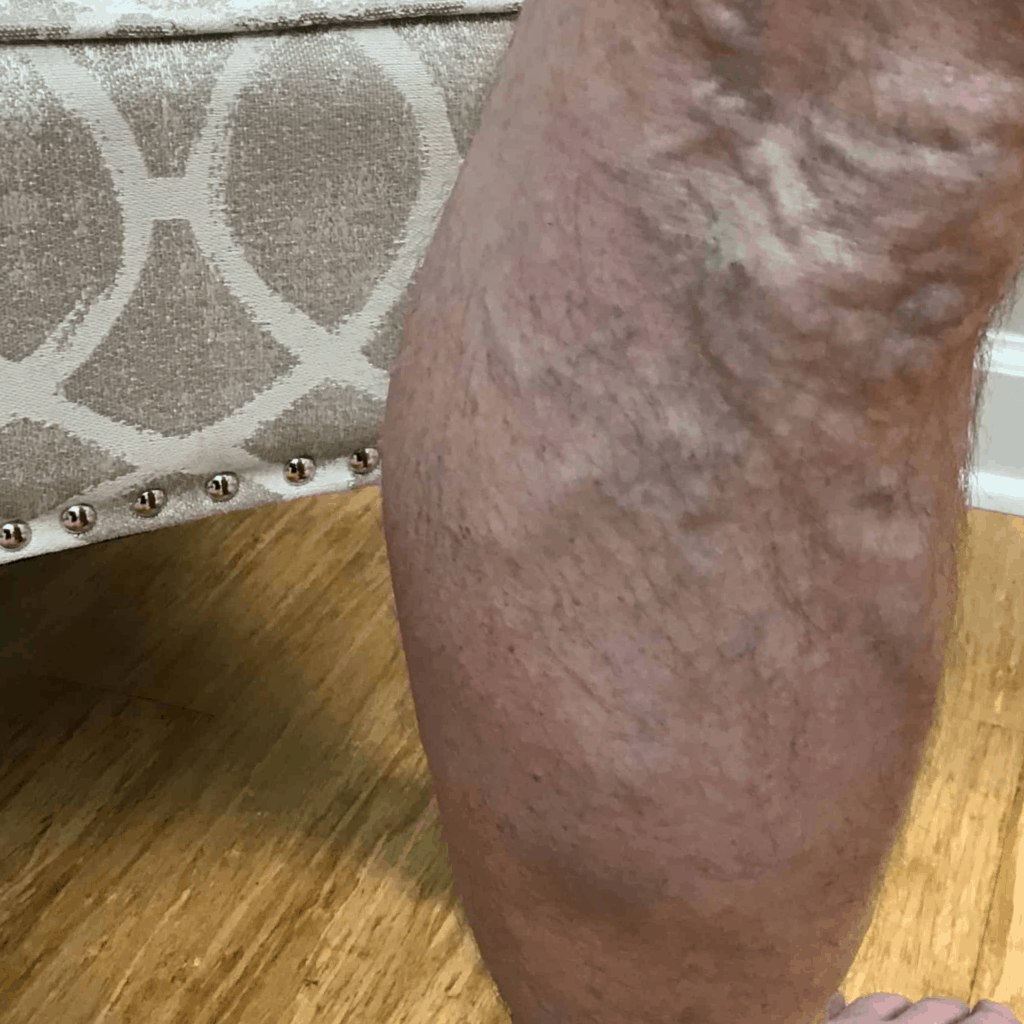 What is Venous Insufficiency? - Vein Care Center of Amelia Island